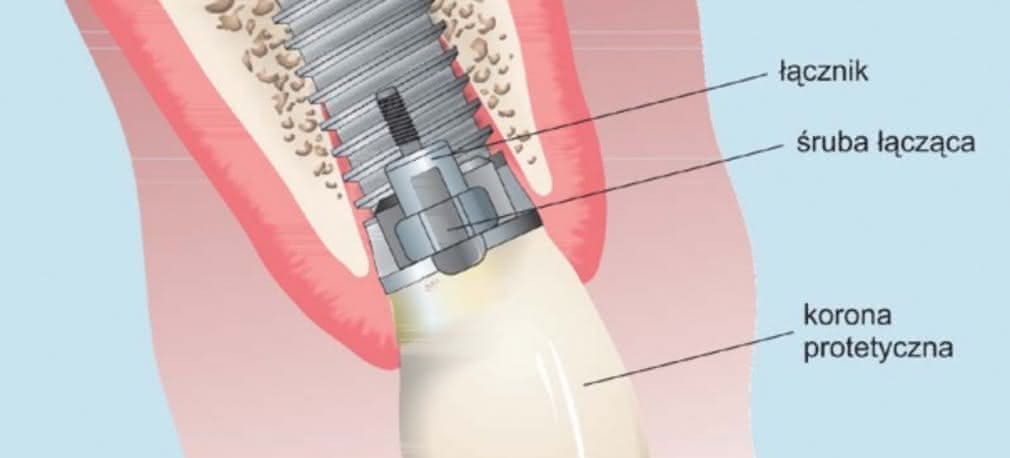 Zęby na śrubki i nakrętki