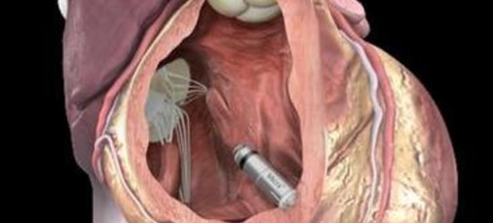 Najmniejszy rozrusznik już w polskich sercach