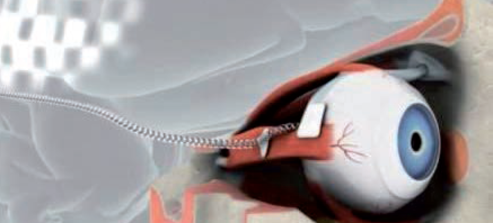 Pierwszy implant bionicznego oka