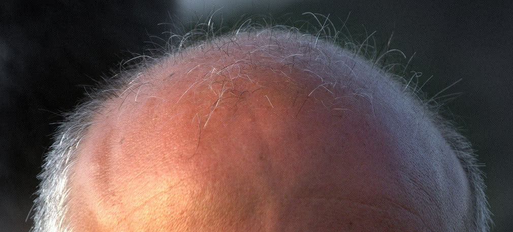 McDonald's sposobem na łysienie