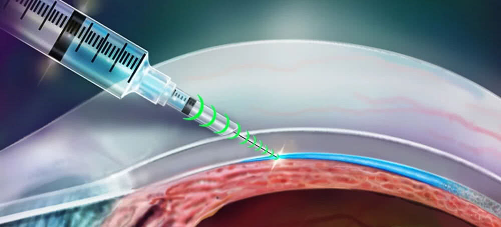 Inteligentne zastrzyki