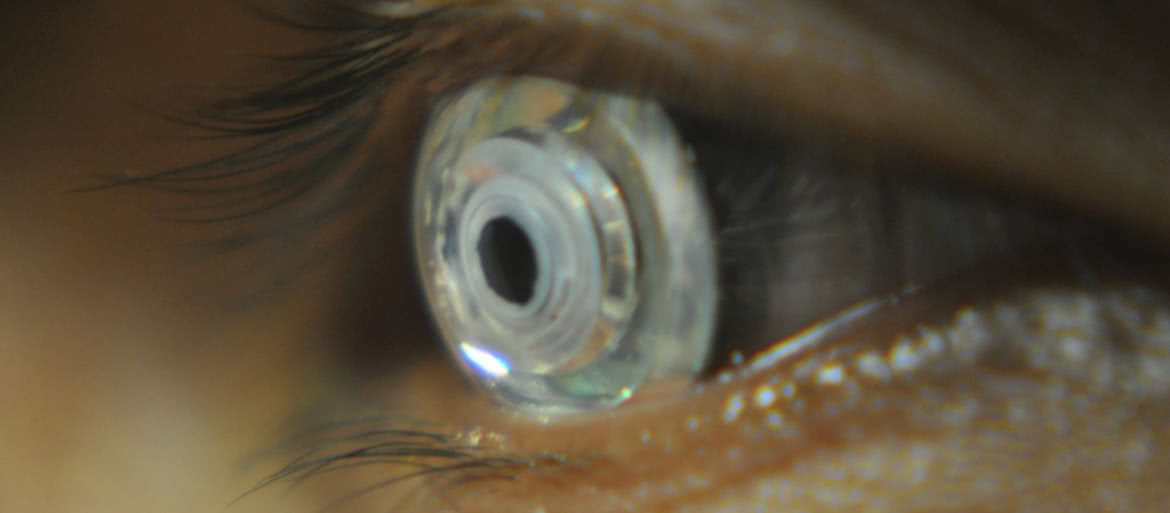 Zoom na mrugnięcie okiem - soczewki kontaktowe, które przybliżają obserwowany obraz